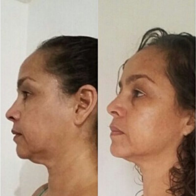 Paquete Especial Corporal + Facial